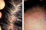 Hair Color Allergy Treatment Pictures