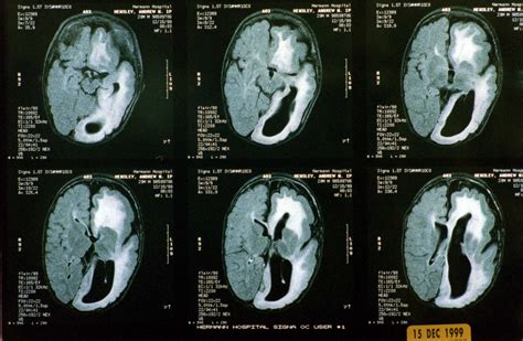 Study Shows Certain Brain Tumors May Run In Families Houston Chronicle