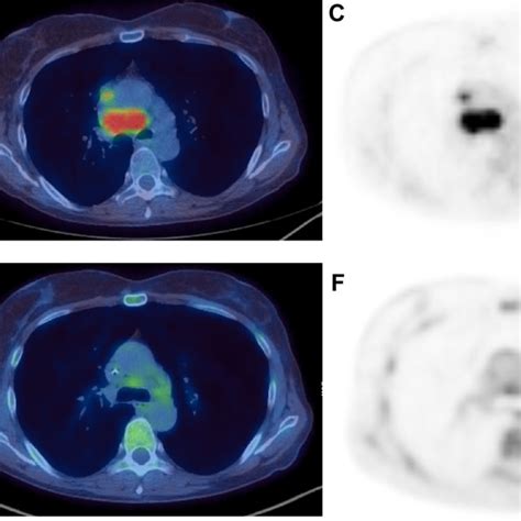 Baseline And Post Treatment Pet Ct In A Patient With Hodgkin Lymphoma