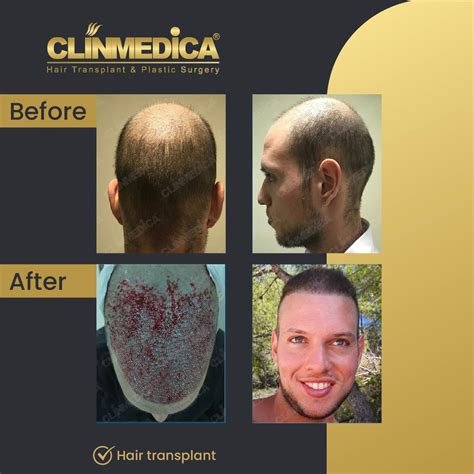 Hair Transplant Before And After Results Clinmedica Turkey