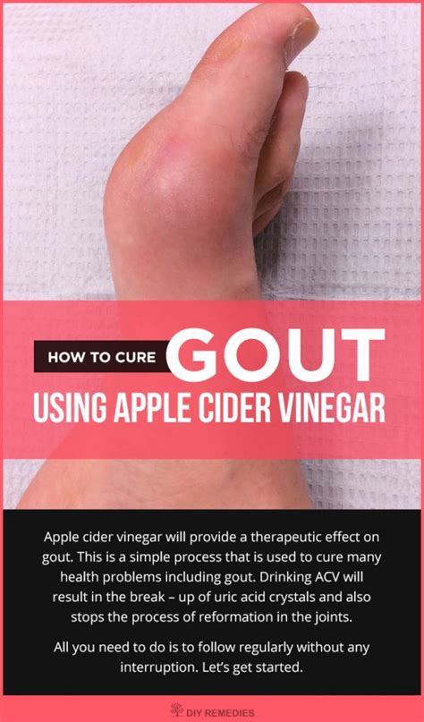 See more of how to cure gout on facebook. How to use Apple Cider Vinegar for Gout