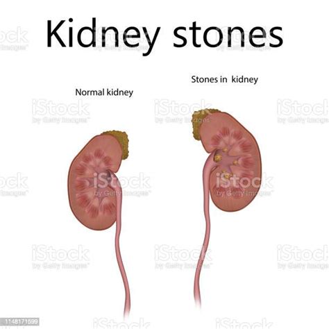 Kidney Stones Normal Healthy Urolithiasis Renal Lithiasis