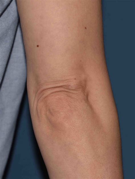 Elbow Skin Excess Explore Plastic Surgery