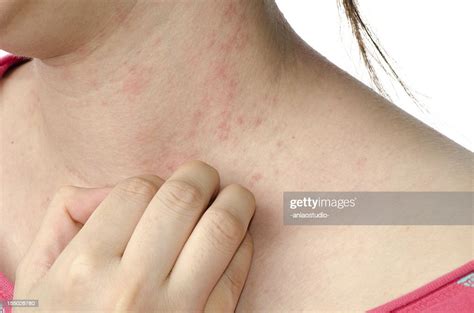 Eczema Skin On Neck High Res Stock Photo Getty Images