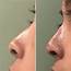 Non Surgical Nose Job In NYC –Rhinoplasty For Men And Women Goshen 