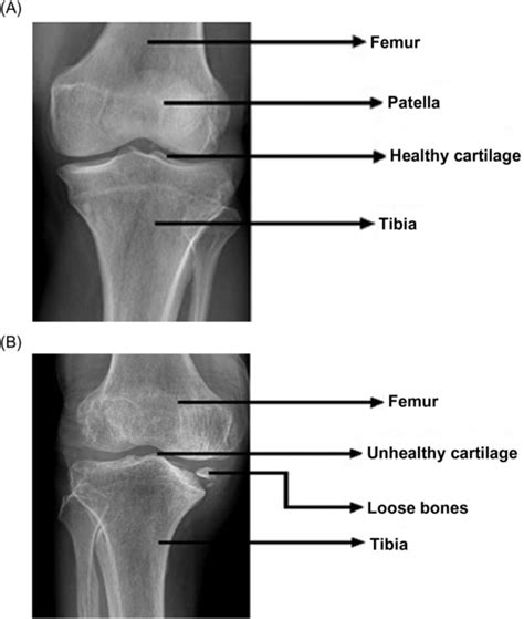 1 A Normal Knee And B Osteoarthritis Knee Download Scientific