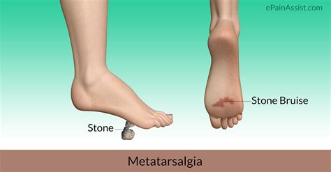 There is a slight tenderness but no pain either or rest or while walking. Stone Bruise: Treatment, Symptoms, Causes