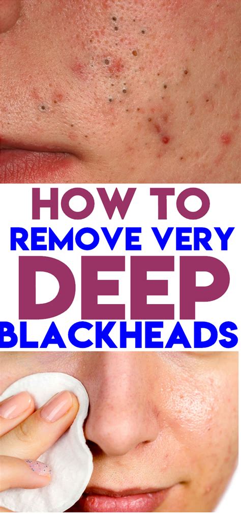 How To Remove Very Deep Blackheads Deep Blackheads Blackheads Anti