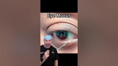 Eye Mucus Strings Are Real 😱 Shorts Youtube