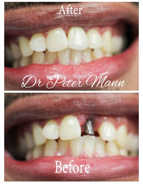 Dental Implants Before And After Photo Manhattan Dentist