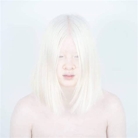 Abandoned As A Baby Due To Albinism Xueli Grew Up To Become A Vogue