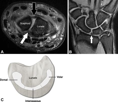 Preoperative And Postoperative Imaging Of Scapholunate Ligament Primary Repair And Modified