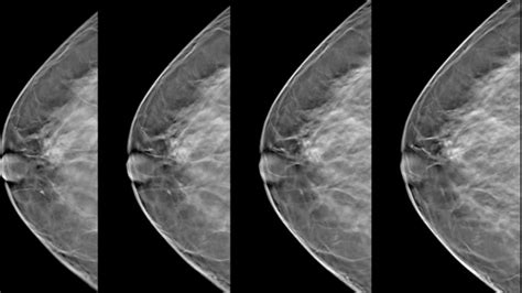 Clinical Minutes 3d Tomosynthesis Mammography Broadcastmed