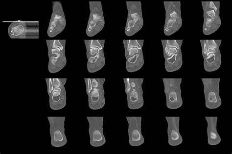 What Is An Ankle Ct Or Cat Scan Two Views