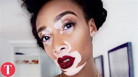 10 Beautiful Women With Very Rare Skin Conditions Youtube