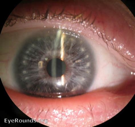 Atlas Entry Downs Syndrome With Brushfields Spots On The Iris