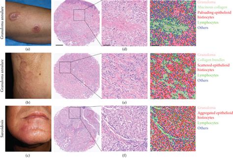 Granuloma Annulare And Sarcoidosis A B Clinical Photographs For