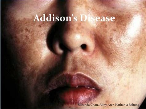 Ppt Addisons Disease Powerpoint Presentation Free Download Id2843179