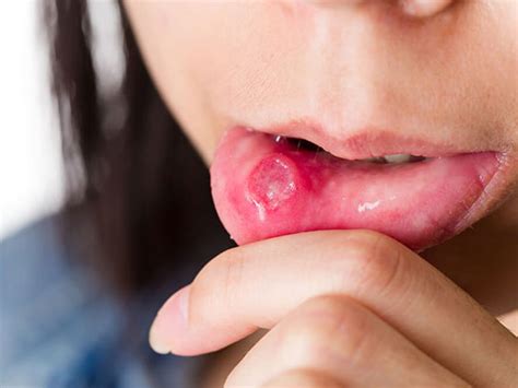 In most cases, mouth ulcers are not caused by an infection. Mouth Ulcers: Causes, Symptoms, Treatment & Prevention ...
