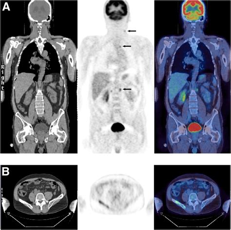 Petct For Therapy Response Assessment In Lymphoma Journal Of Nuclear