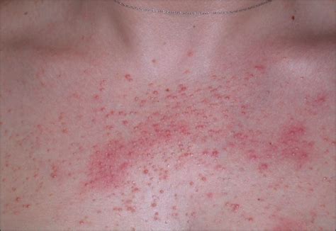 Eruptive Milia And Rapid Response To Topical Tretinoin Dermatology