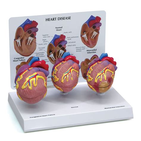 Buy Heart Model Set Human Body Anatomy Replica Heart Disease Set For