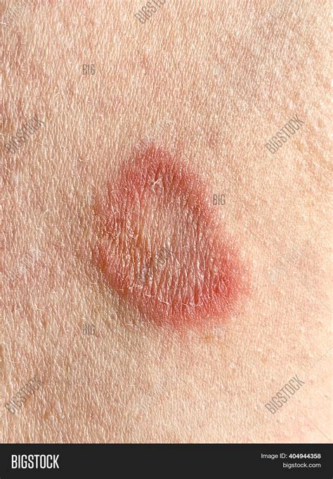 Ringworm Infection On Image And Photo Free Trial Bigstock
