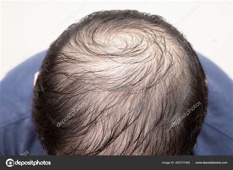 Bald Head Top View Ph