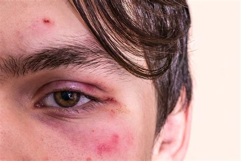 Personal Injury Claims After An Assault Polaris Lawyers