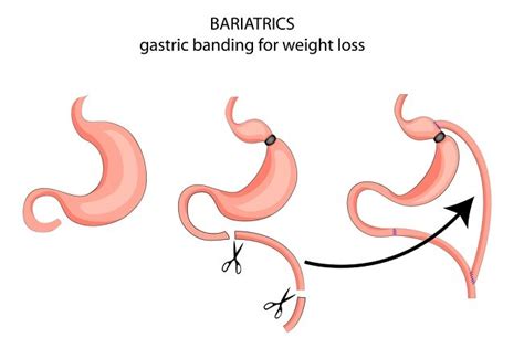 Bariatric Surgery Types Benefits And Risks