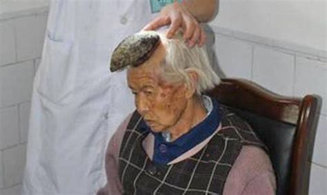 Η γυναίκα… μονόκερος Δείτε πώς εξελίχθηκε μια κρεατοελιά στο κεφάλι Βίντεο kontranews gr