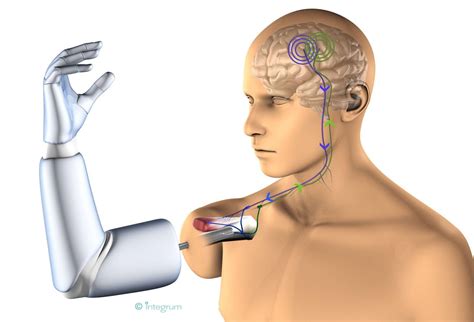 Mind Controlled Permanently Attached Prosthetic Arm Could Revolutionize