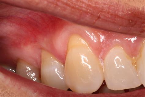 Receding Gums Causes Prevalence And Treatment Ryan Lanman Dds Msd