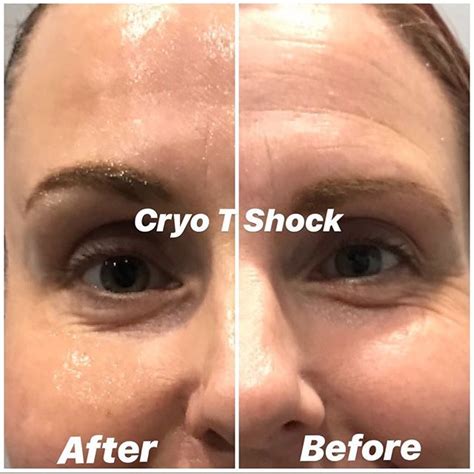 The solutions that are used contain special. Cryo T Shock Facials | Active Health & Wellness