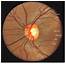 Normal Optic Disc  Physical Diagnosis Mitch Medical Healthcare