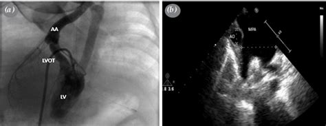 Imaging Studies Of Case 1 A Thin And Elongated Lvot On Angiography