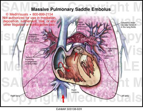 Massive Pulmonary Saddle Embolus Medical Illustration