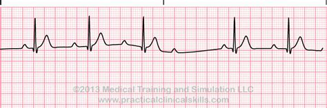 Different Types Of Heart Block — From New To Icu