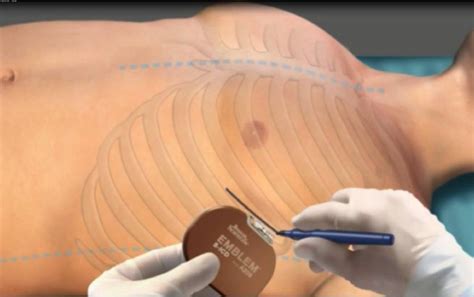 Implant Procedure For Emblem Mri S Icd Boston Scientific