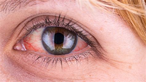 ojo seco causas síntomas y tratamientos visual Ópticos