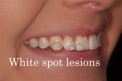 White Spot Lesion From Braces What Can You Do Now