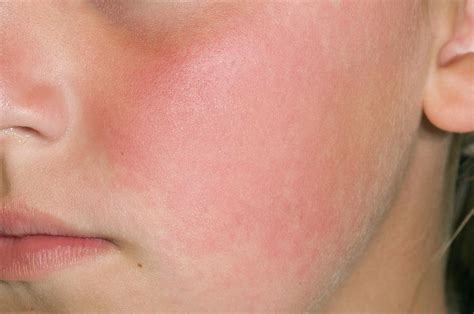 Slapped Cheek Fifth Disease Photograph By Dr P Marazziscience Photo