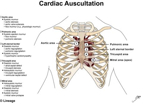 Heart Murmurs Cardiovascular Medbullets Step 1 Heart Murmur