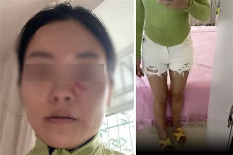 ‘scratched And Scalded’ Chinese Woman Accuses Father In Law Who Took Exception To Her ‘hot