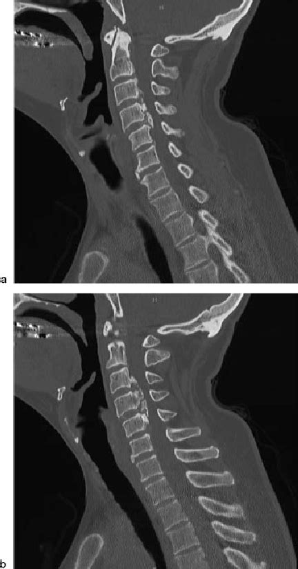 A Parasagittal Preoperative Ct Image Demonstrating Severe