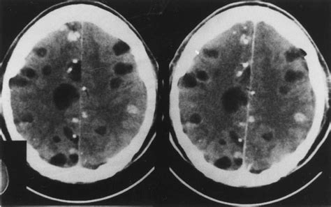 Typical Image Of Cysticerci Ct Scan Showing Many Active Cysts