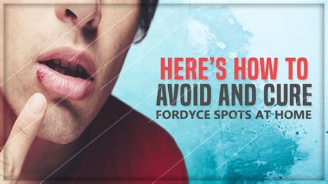 Fordyce Spots How Do You Get Rid Of Fordyce Spots On Lips At Home