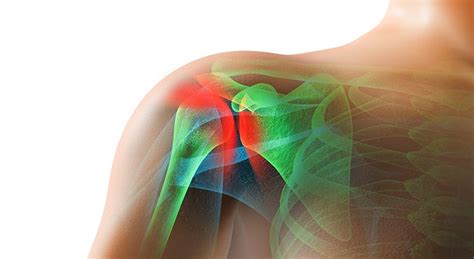 Shoulder Impingement Causes Symptoms Diagnosis And Treatment