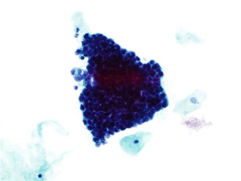 Pathology Outlines Atypical Glandular Cells Cytology