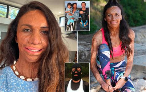 Turia Pitt Accident Video After Before Pics